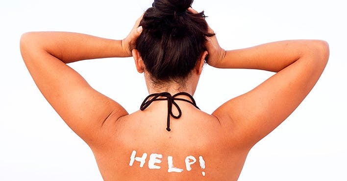 How to Treat a Sunburn