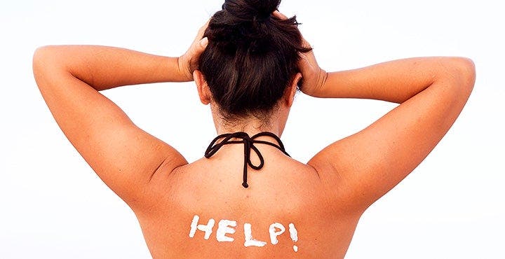 How to Treat a Sunburn