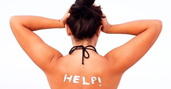 How to Treat a Sunburn